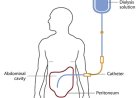 What Are the Reasons Why People Reach the Dialysis Phase?