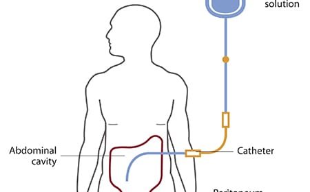 What Are the Reasons Why People Reach the Dialysis Phase?