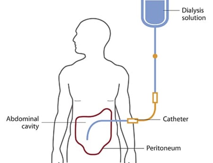 What Are the Reasons Why People Reach the Dialysis Phase?