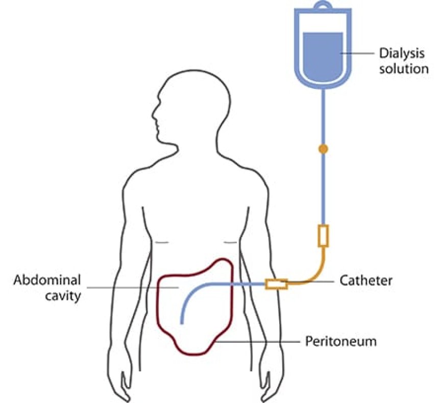 What Are the Reasons Why People Reach the Dialysis Phase?