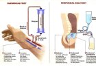 What is the procedure of dialysis?
