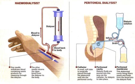 What is the procedure of dialysis?
